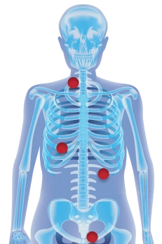 A graphic showing the human body with red dots on areas where the immature white blood cells can cause problems after entering into the bloodstream.