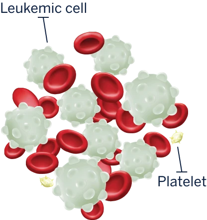 A graphic showing leukemic cells mixed with red blood cells and platelets.